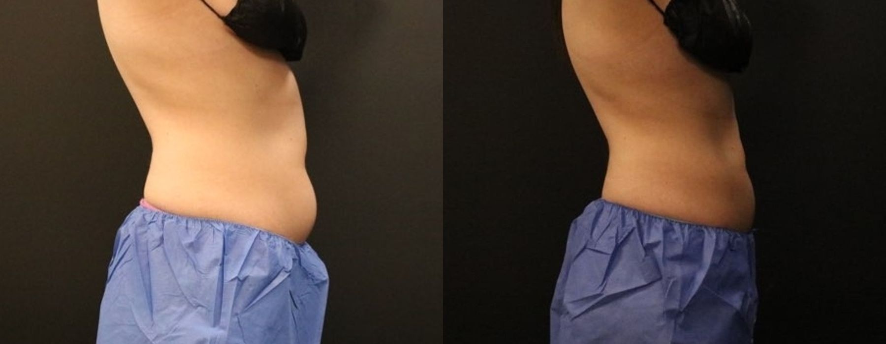 CoolSculpting Elite - Thumbnail 5