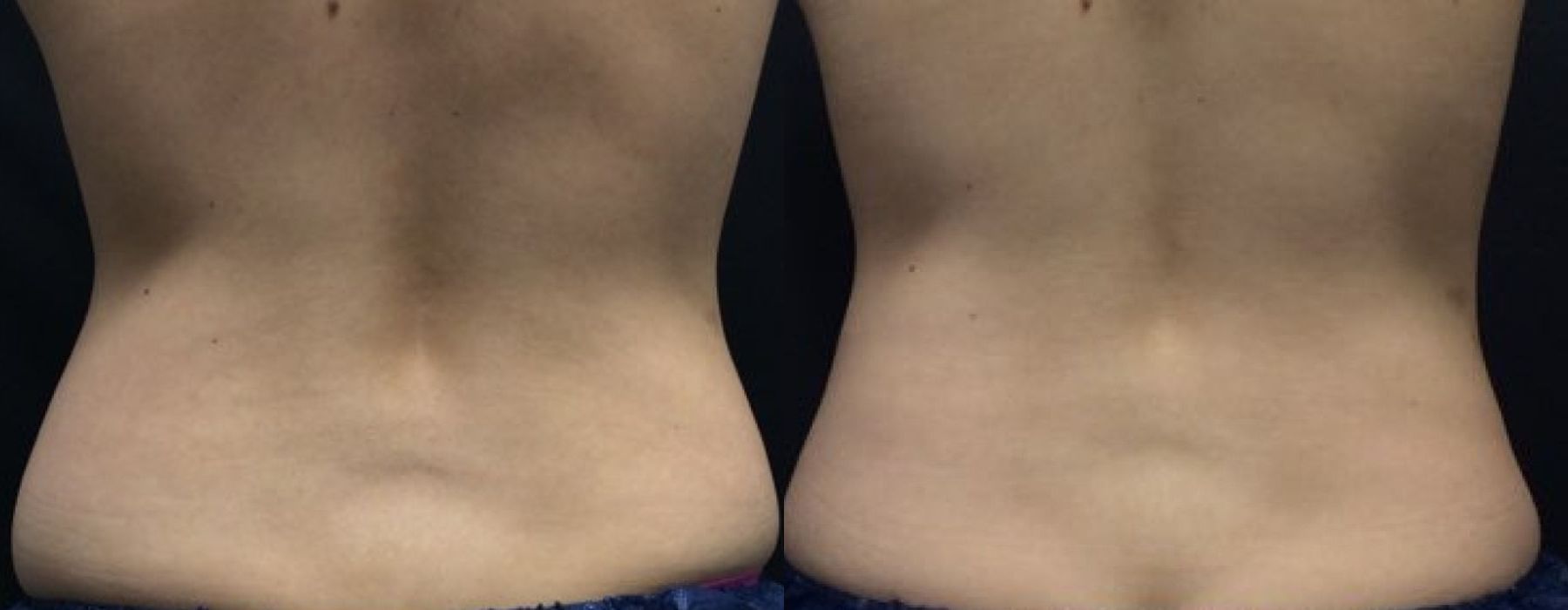 CoolSculpting Elite - Thumbnail 2