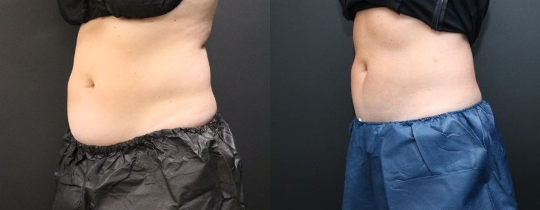 Before and after procedure result