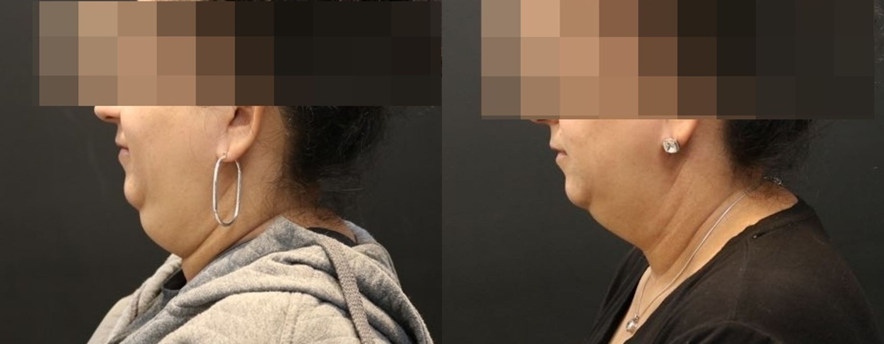 CoolSculpting Elite - Thumbnail 3