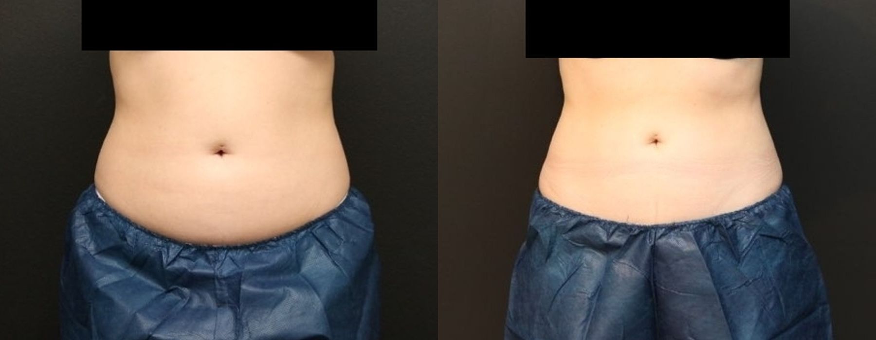 Before and after procedure result