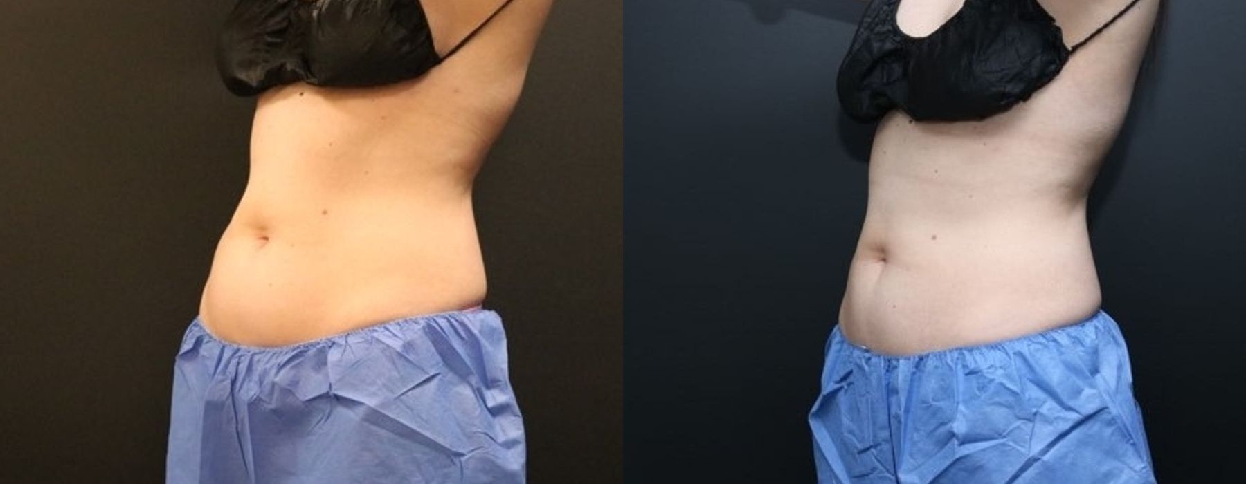 CoolSculpting Elite - Thumbnail 2