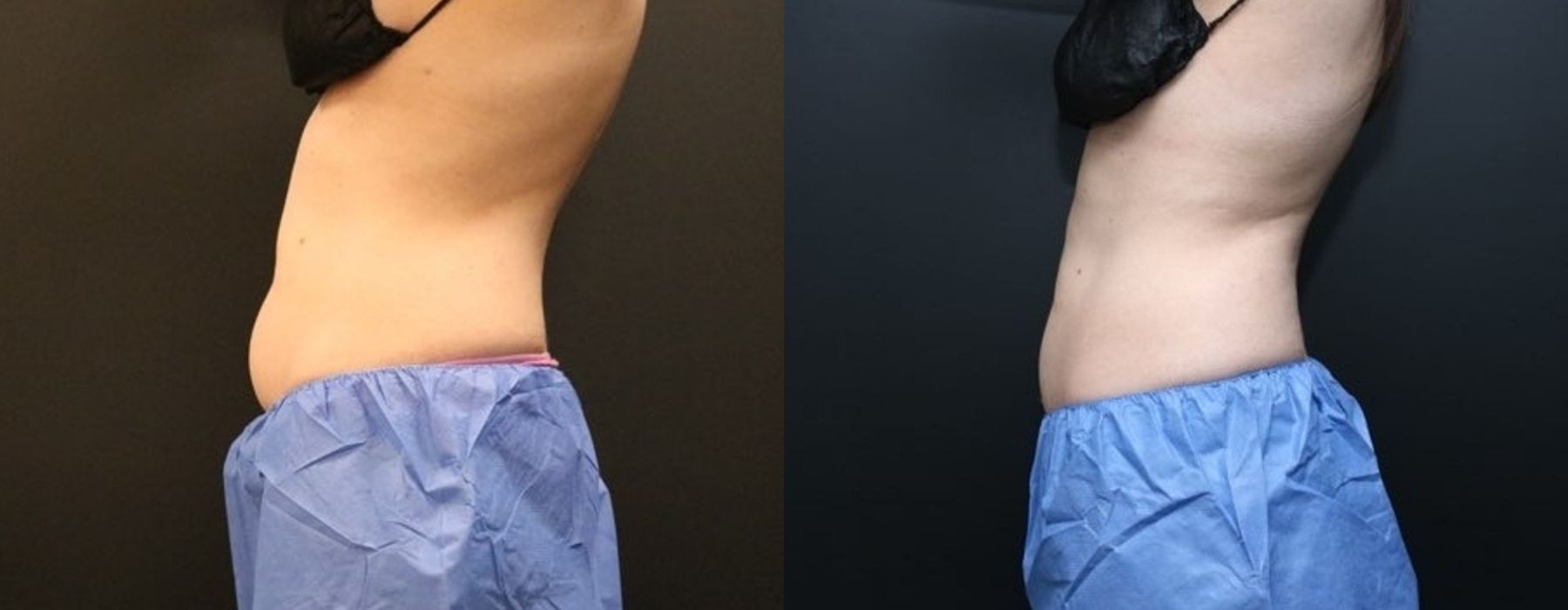 CoolSculpting Elite - Thumbnail 3