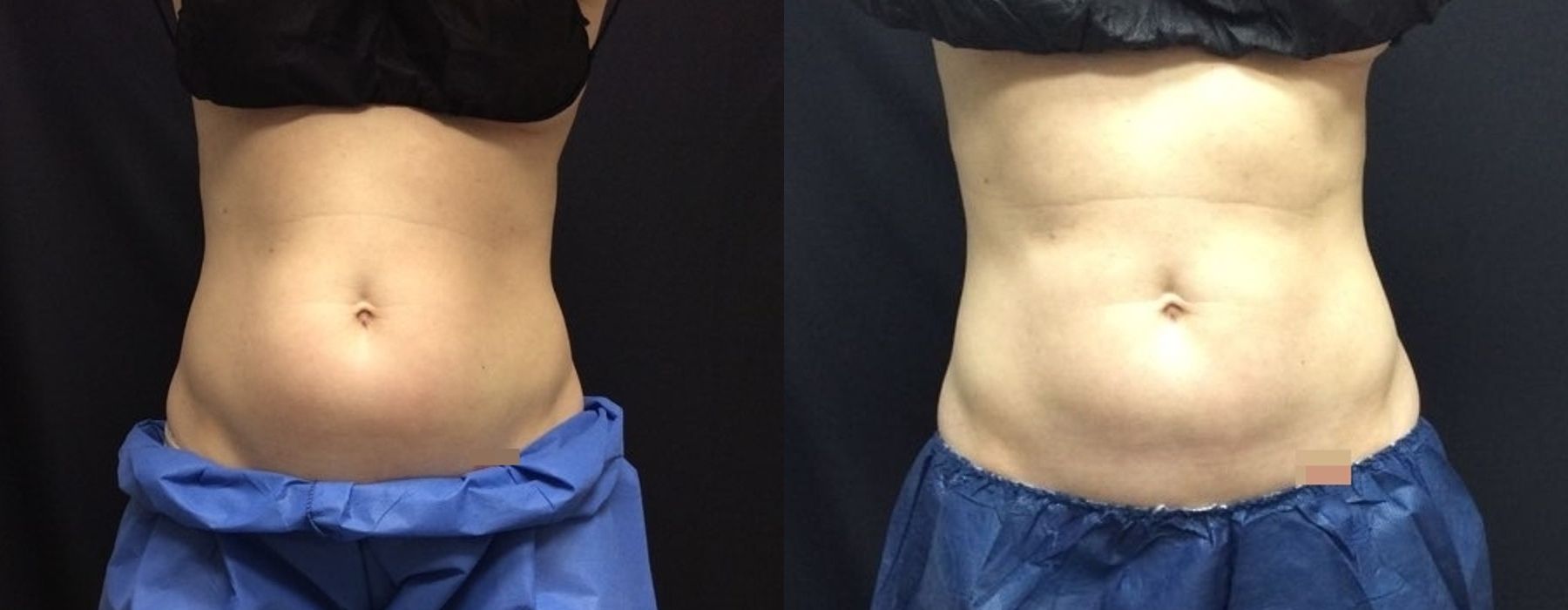 Before and after procedure result