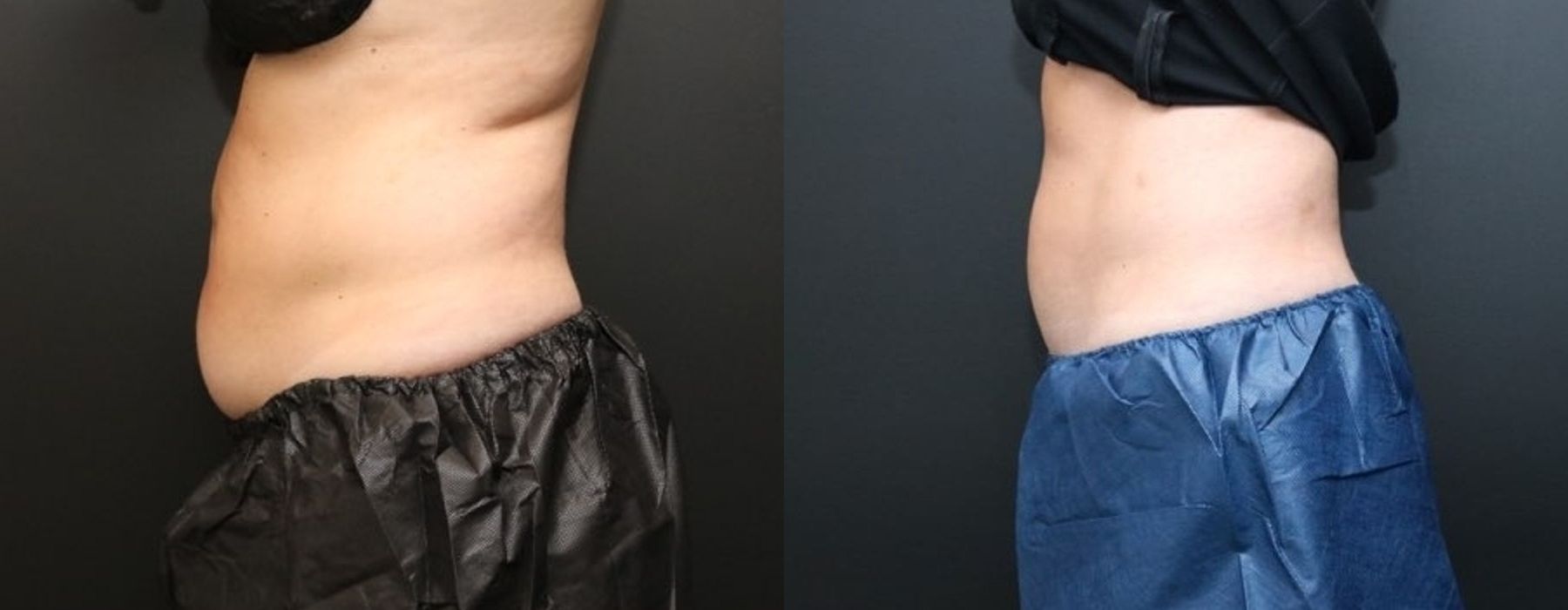 CoolSculpting Elite - Thumbnail 3