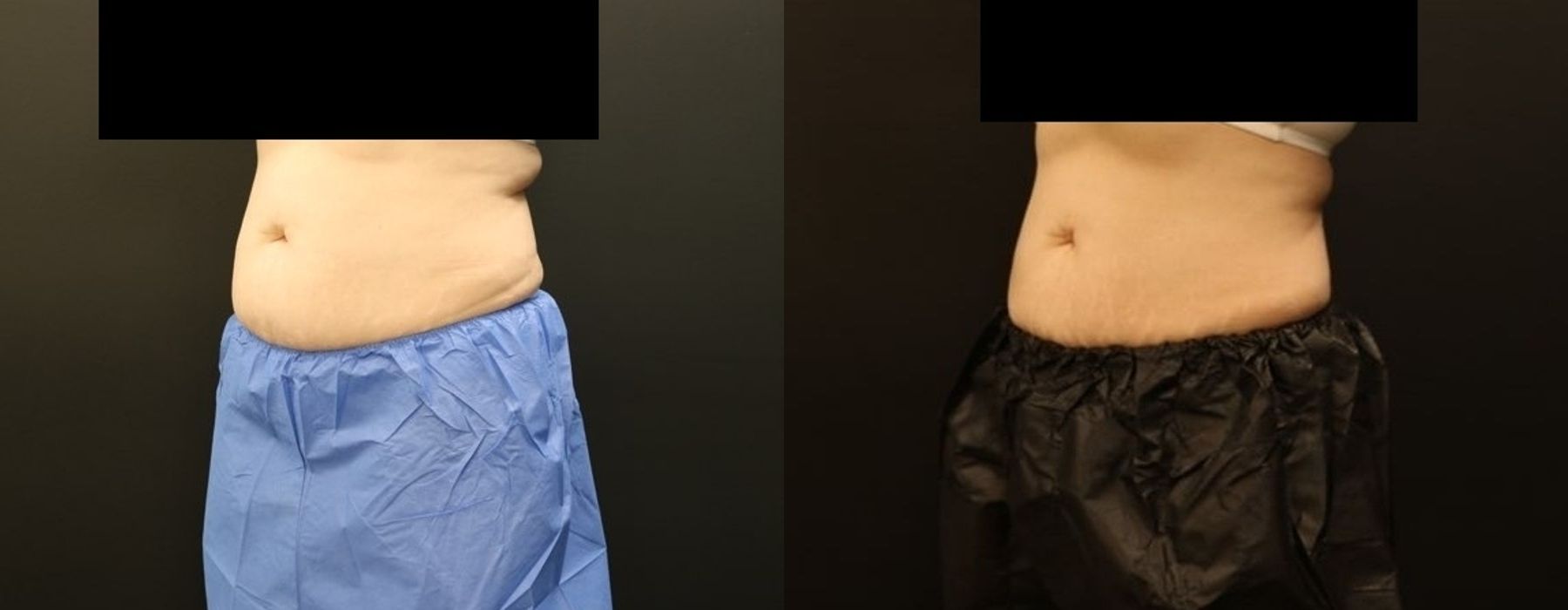 CoolSculpting Elite - Thumbnail 2