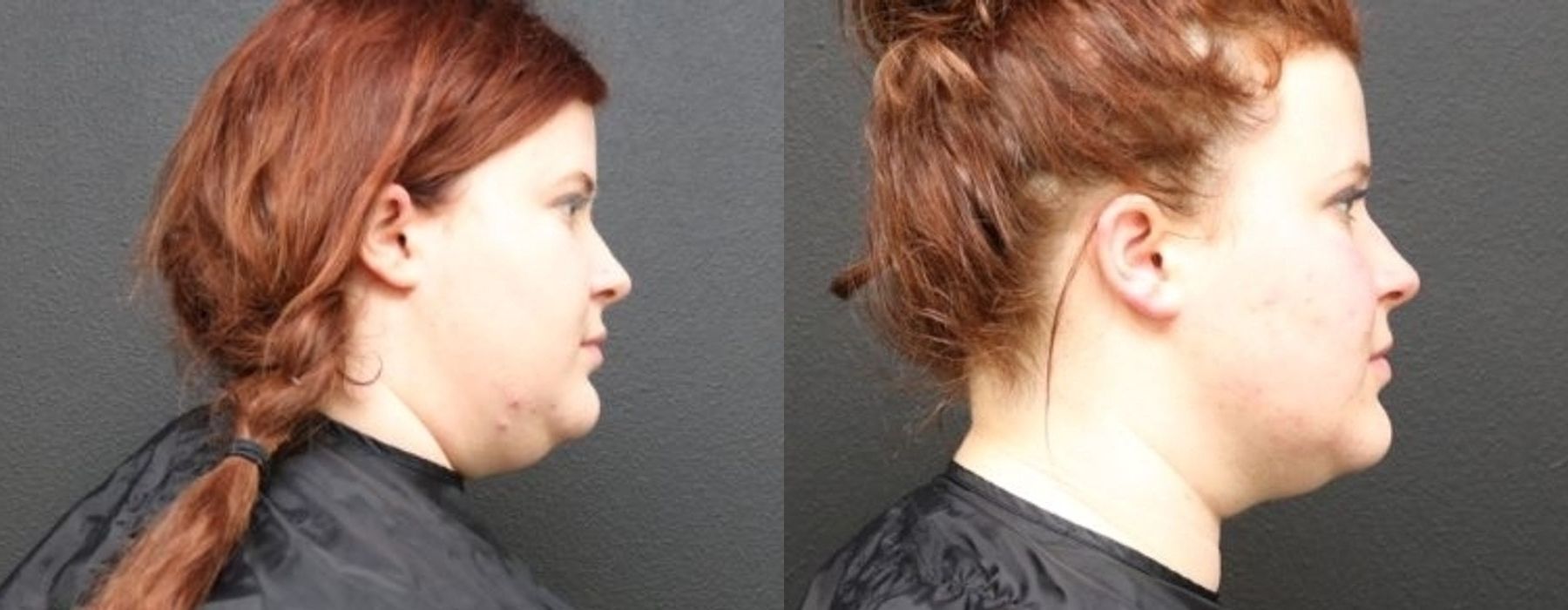 CoolSculpting Elite - Thumbnail 2