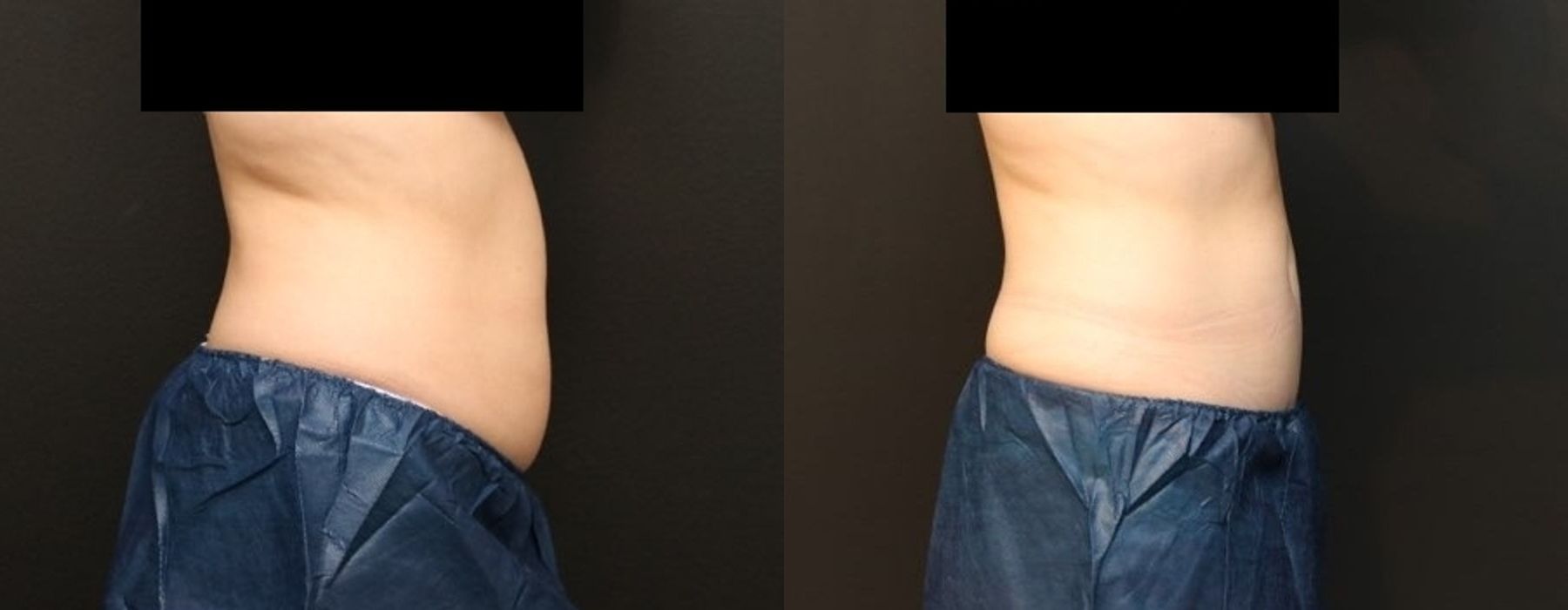 CoolSculpting Elite - Thumbnail 4