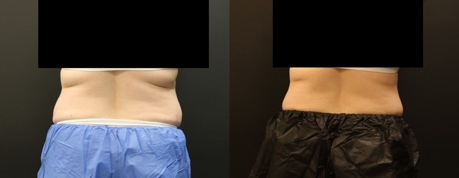 CoolSculpting Elite - Thumbnail 5