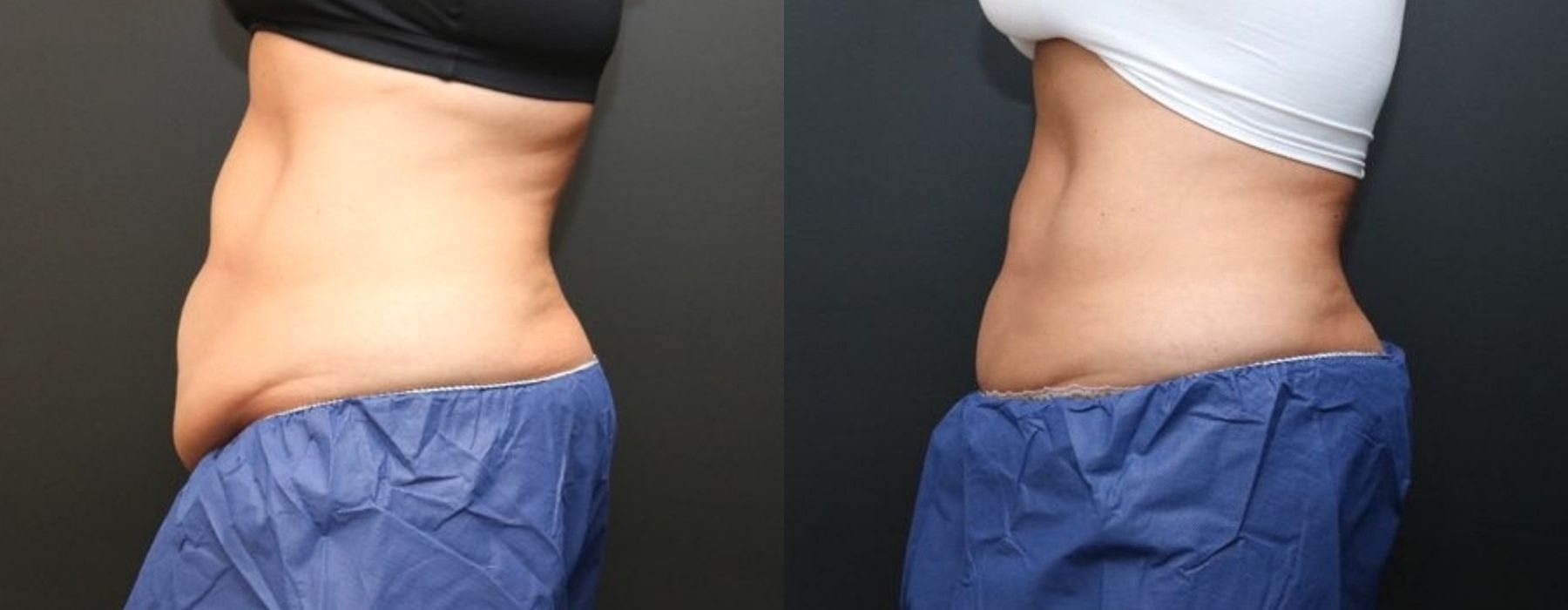 CoolSculpting Elite - Thumbnail 3