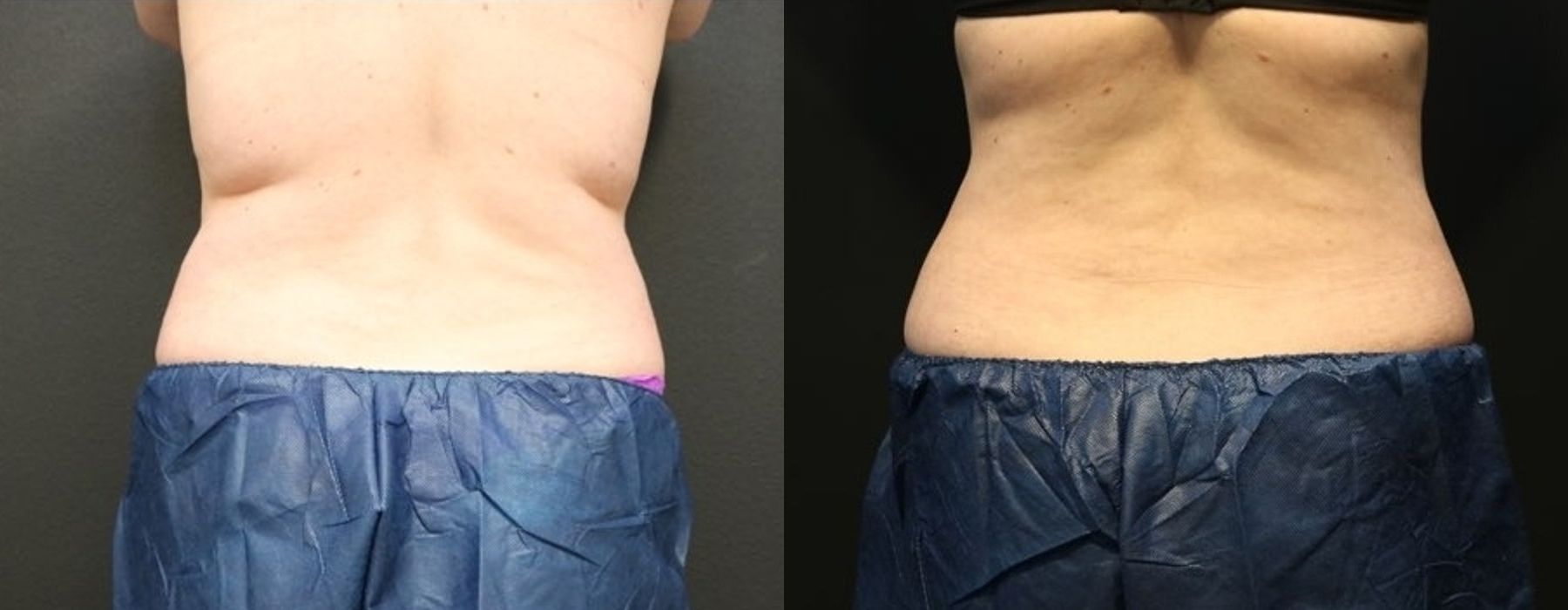 CoolSculpting Elite - Thumbnail 3