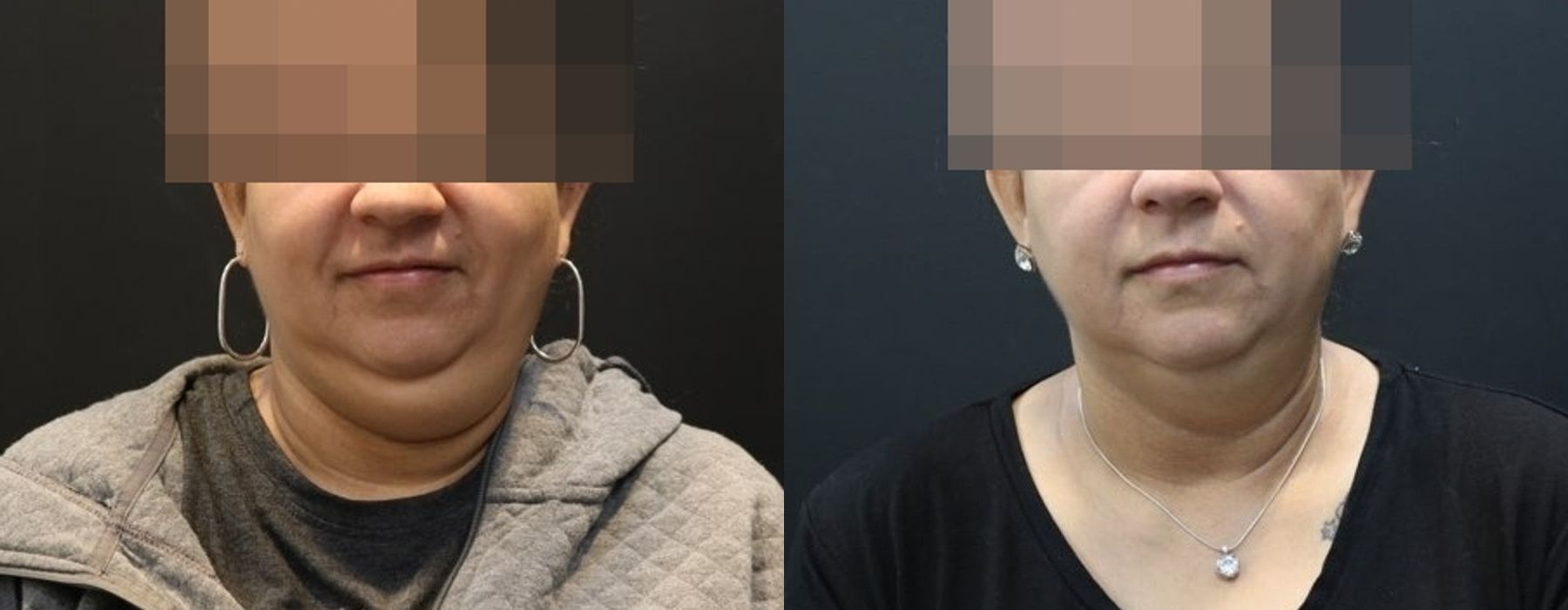 CoolSculpting Elite - Case 5288