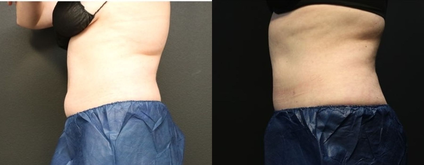 Before and after procedure result