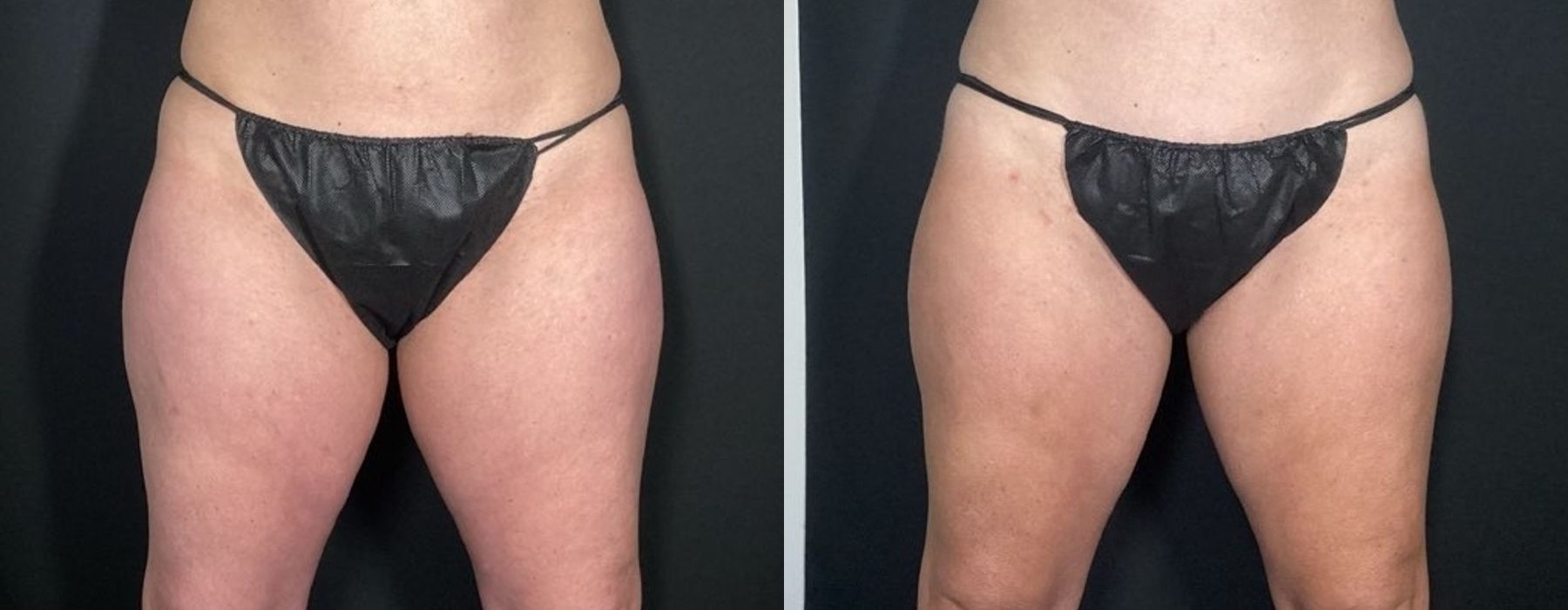 CoolSculpting Elite - Thumbnail 2