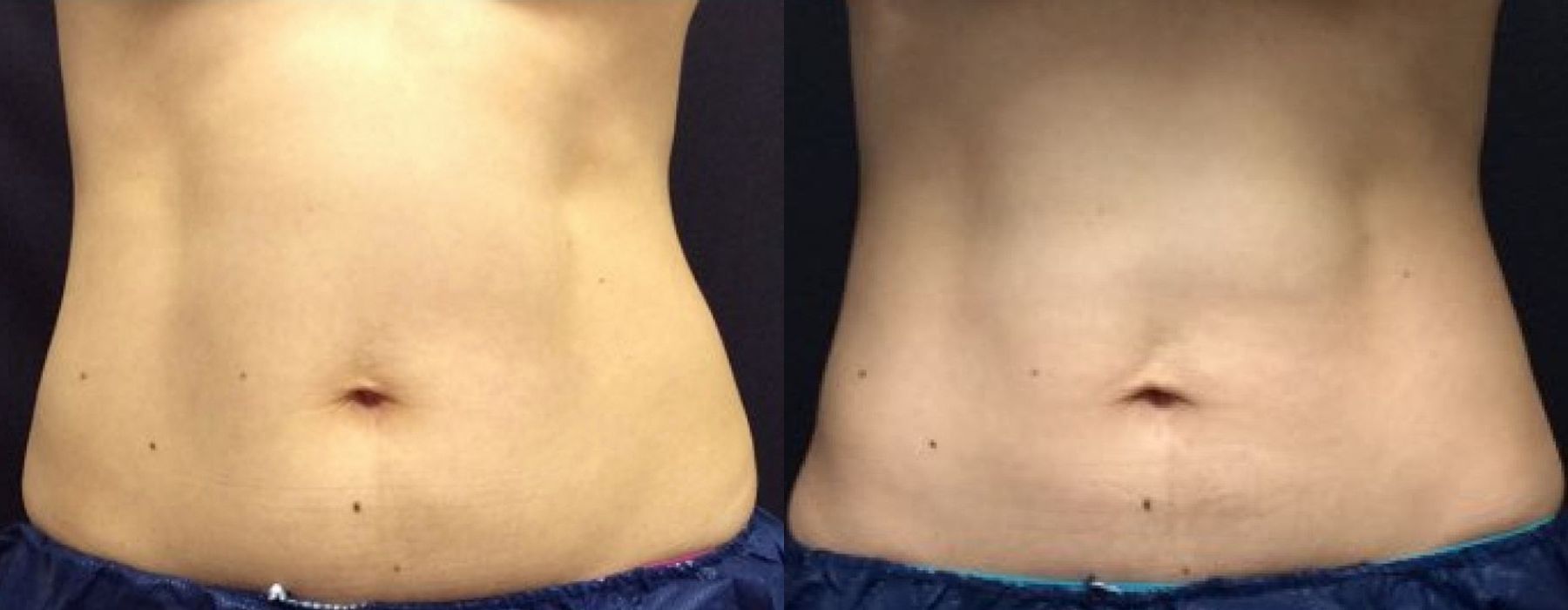 Before and after procedure result