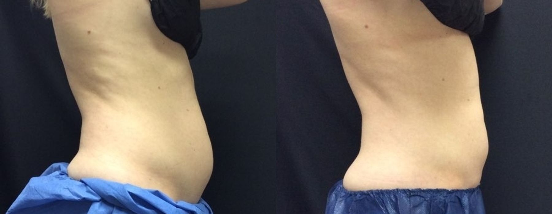 CoolSculpting Elite - Thumbnail 3