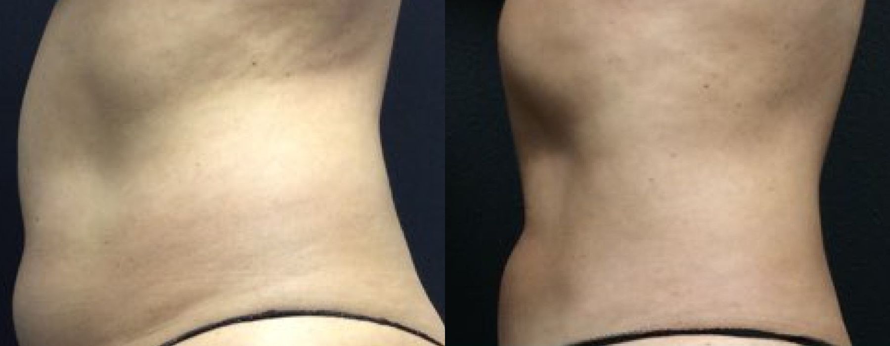 CoolSculpting Elite - Thumbnail 2