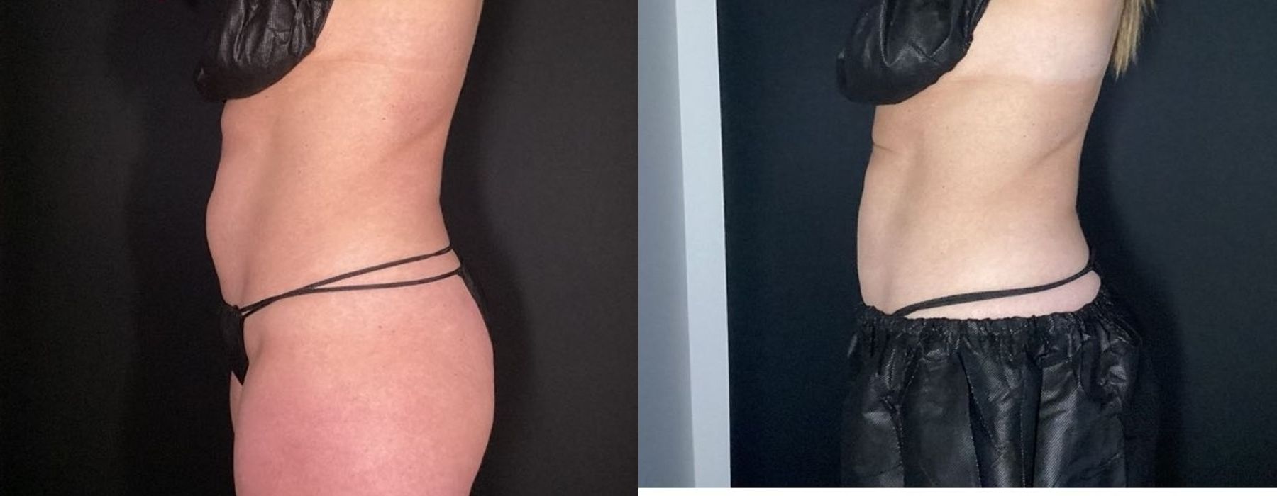 CoolSculpting Elite - Thumbnail 4