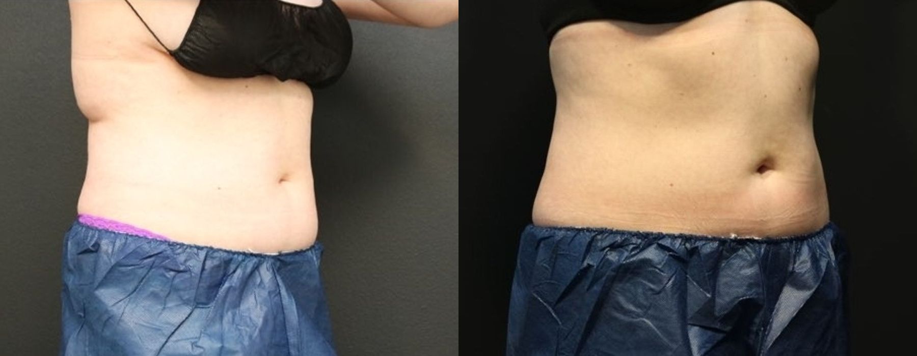 CoolSculpting Elite - Thumbnail 2