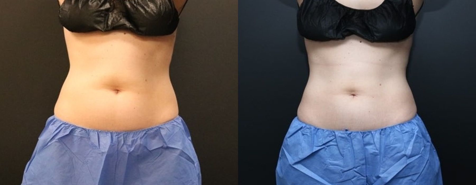 Before and after procedure result