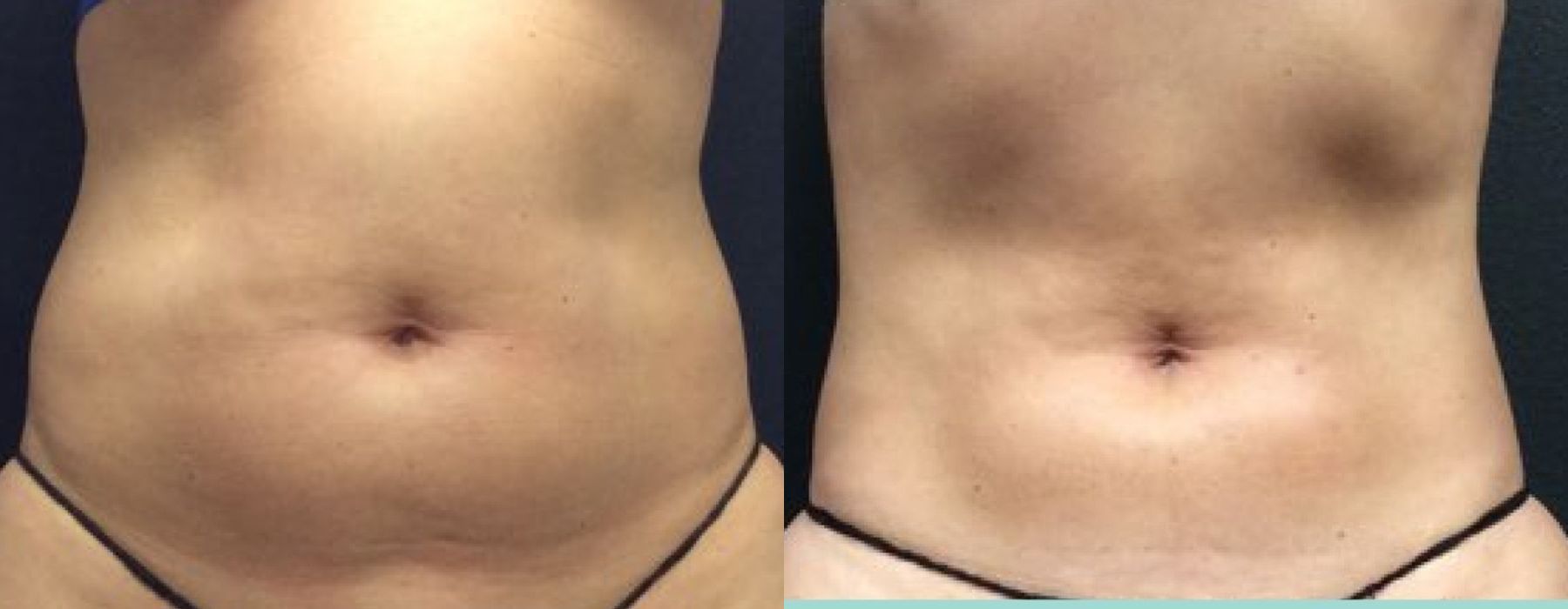 Before and after procedure result