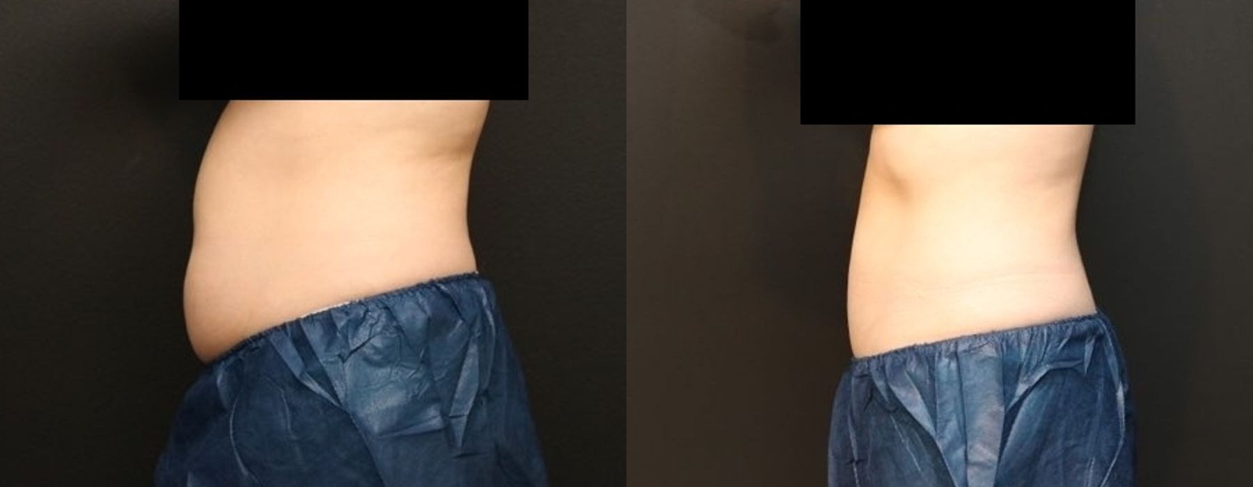 CoolSculpting Elite - Thumbnail 3