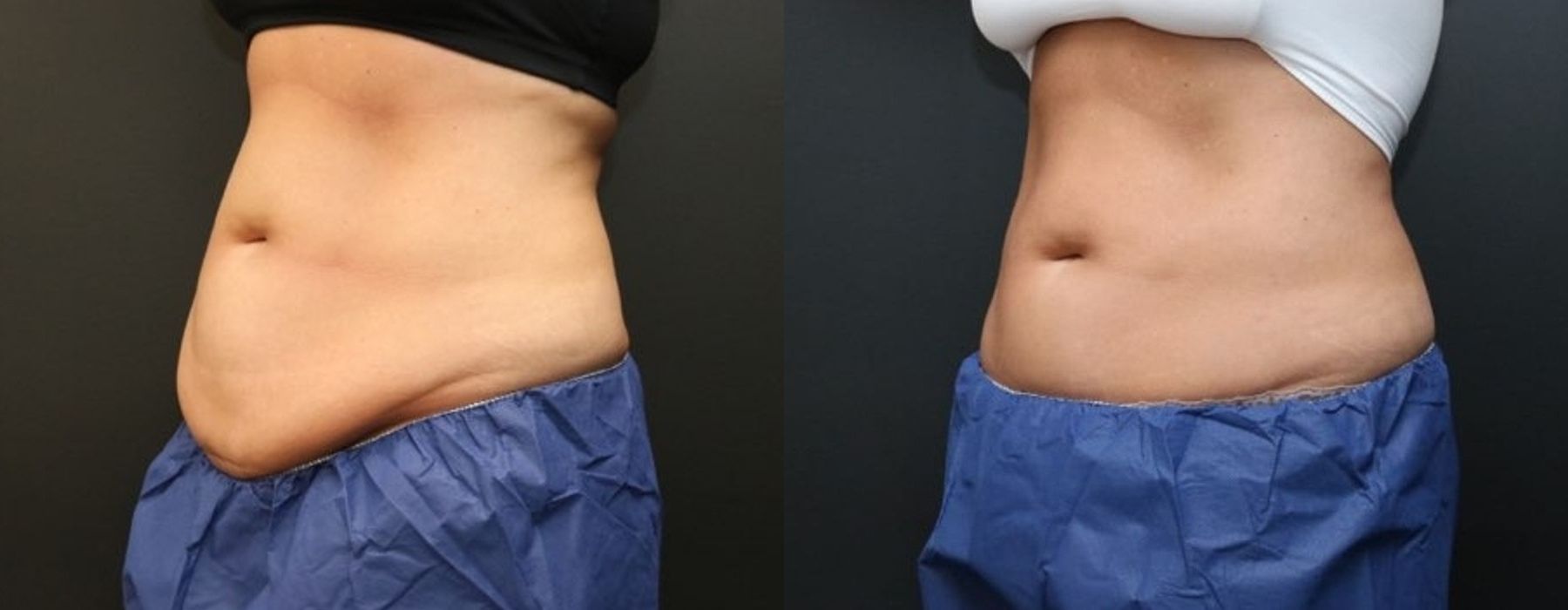 CoolSculpting Elite - Thumbnail 2