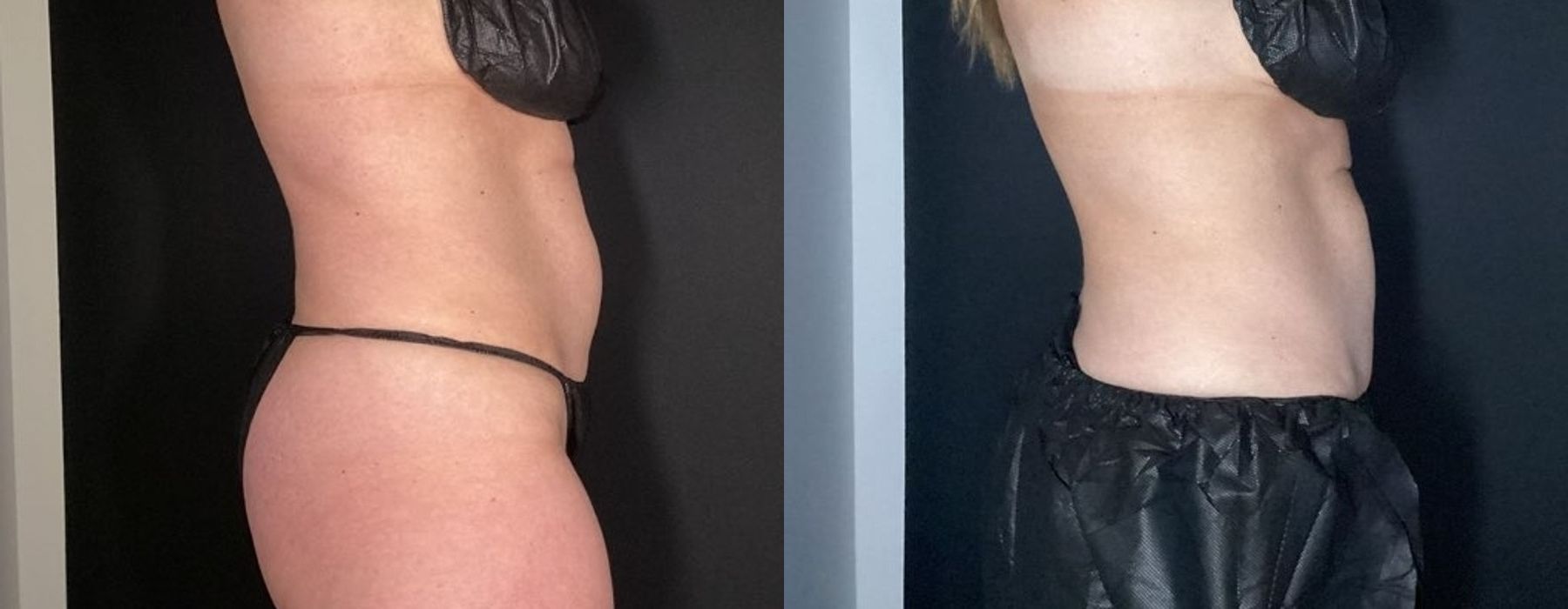 CoolSculpting Elite - Thumbnail 5