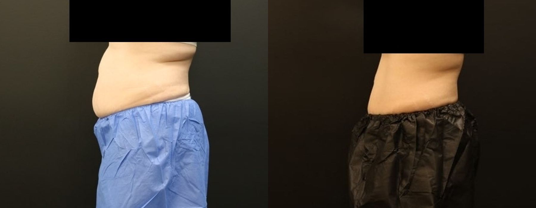 CoolSculpting Elite - Thumbnail 3