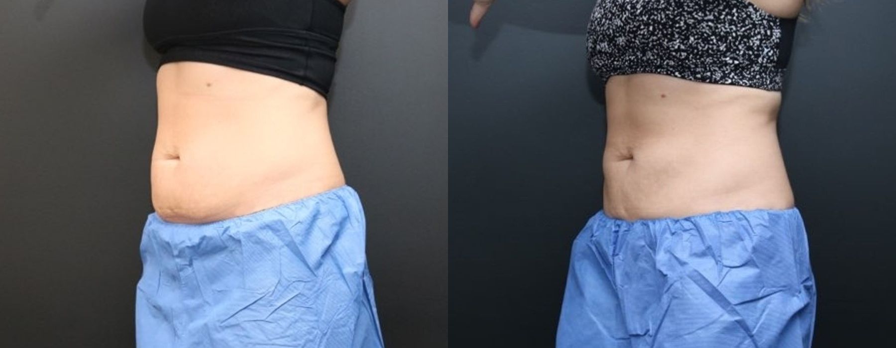 Before photo - Angle 4