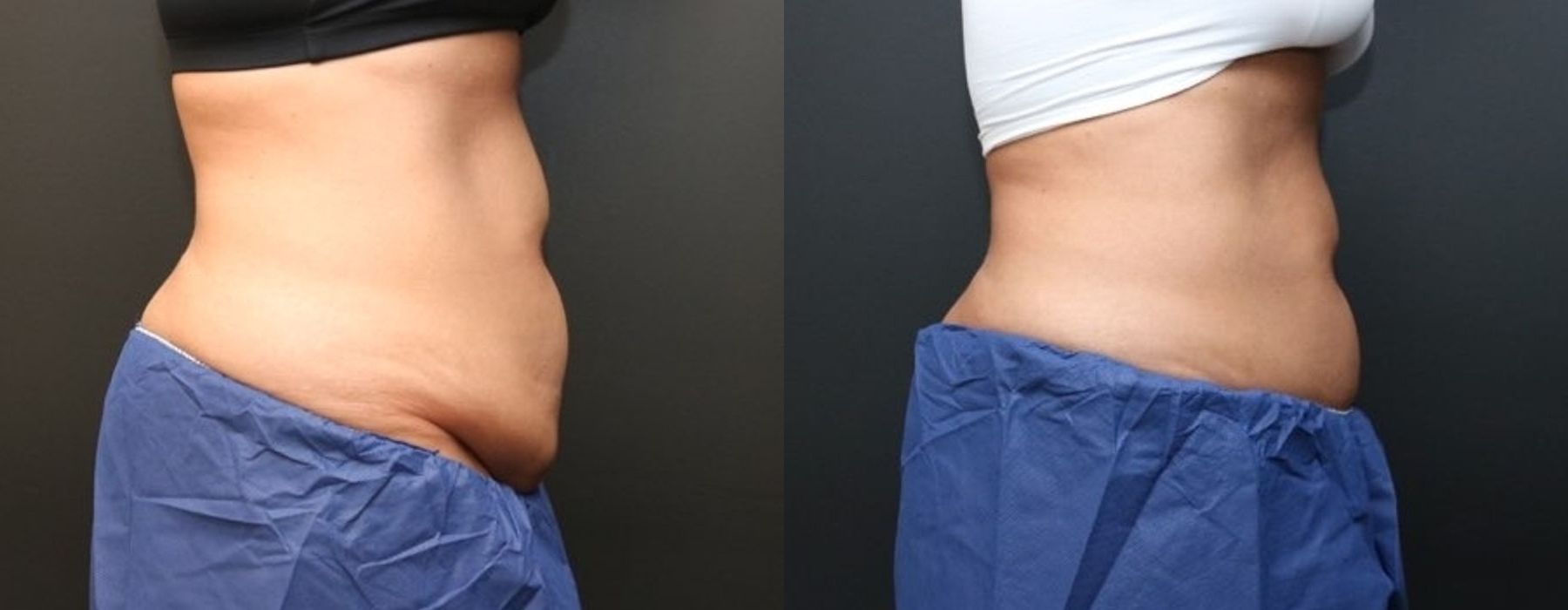 CoolSculpting Elite - Thumbnail 5