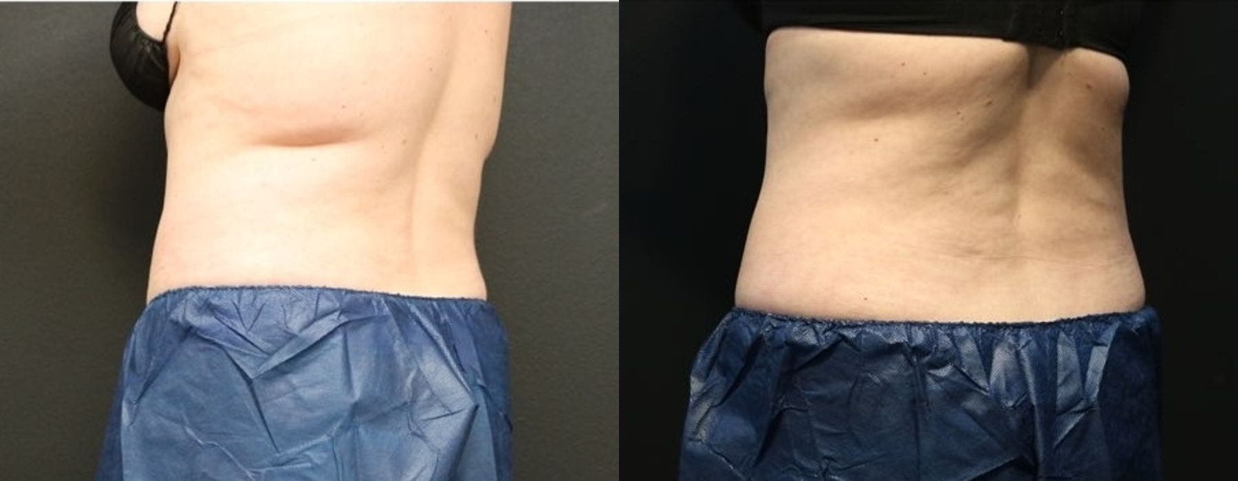 CoolSculpting Elite - Thumbnail 4