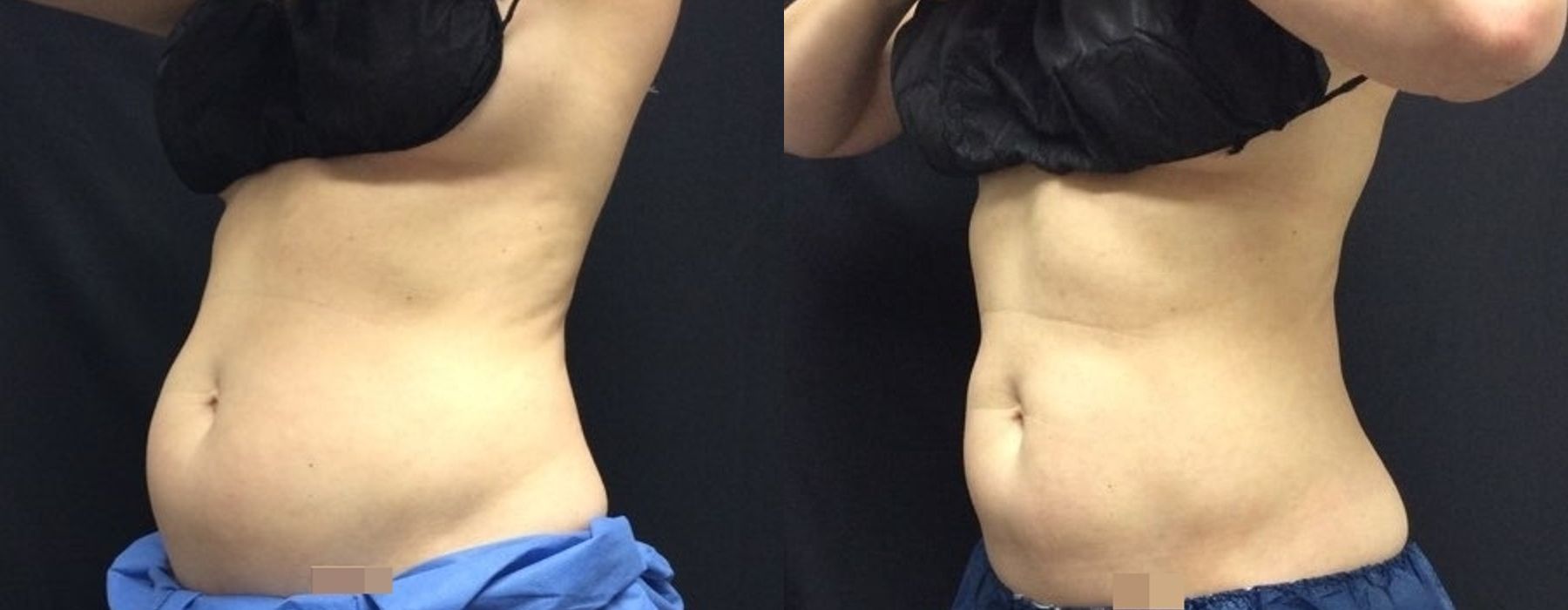 CoolSculpting Elite - Thumbnail 2