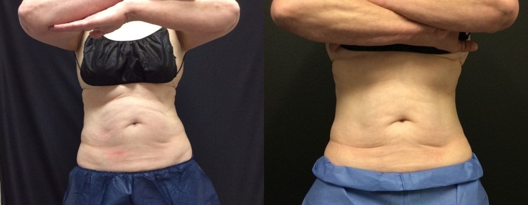 Before and after procedure result