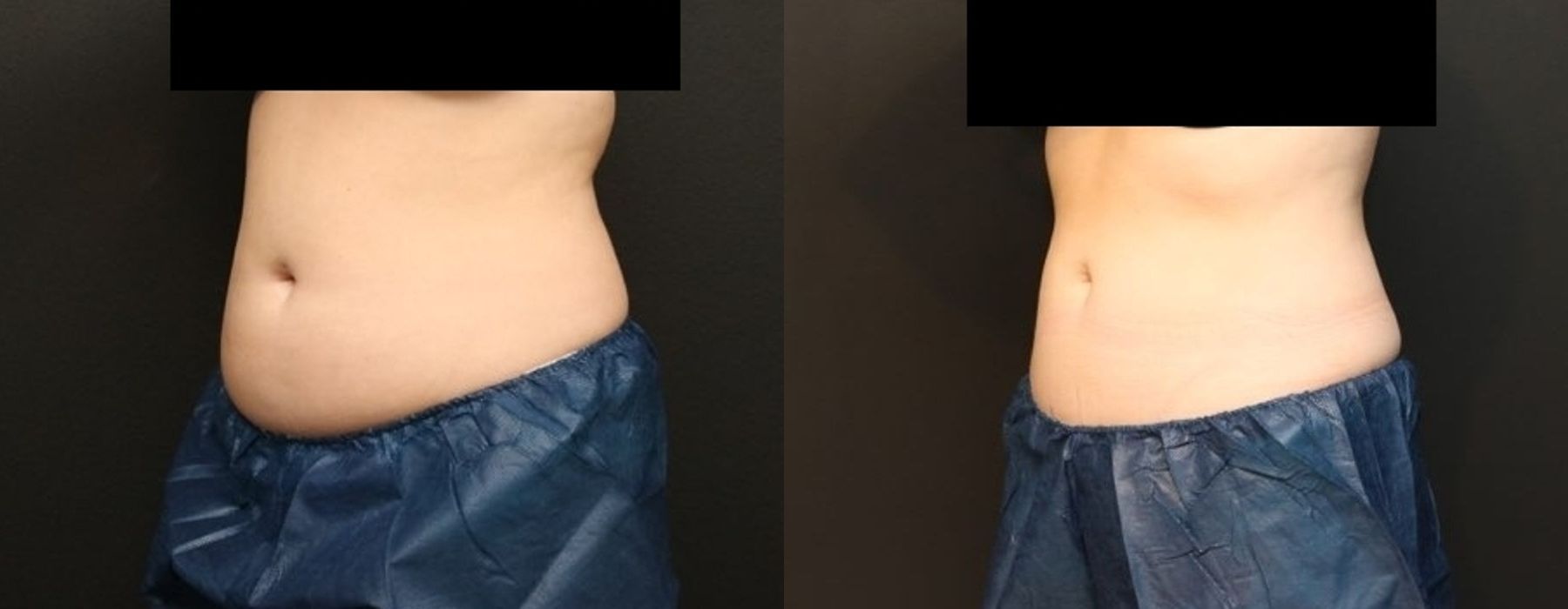 CoolSculpting Elite - Thumbnail 2