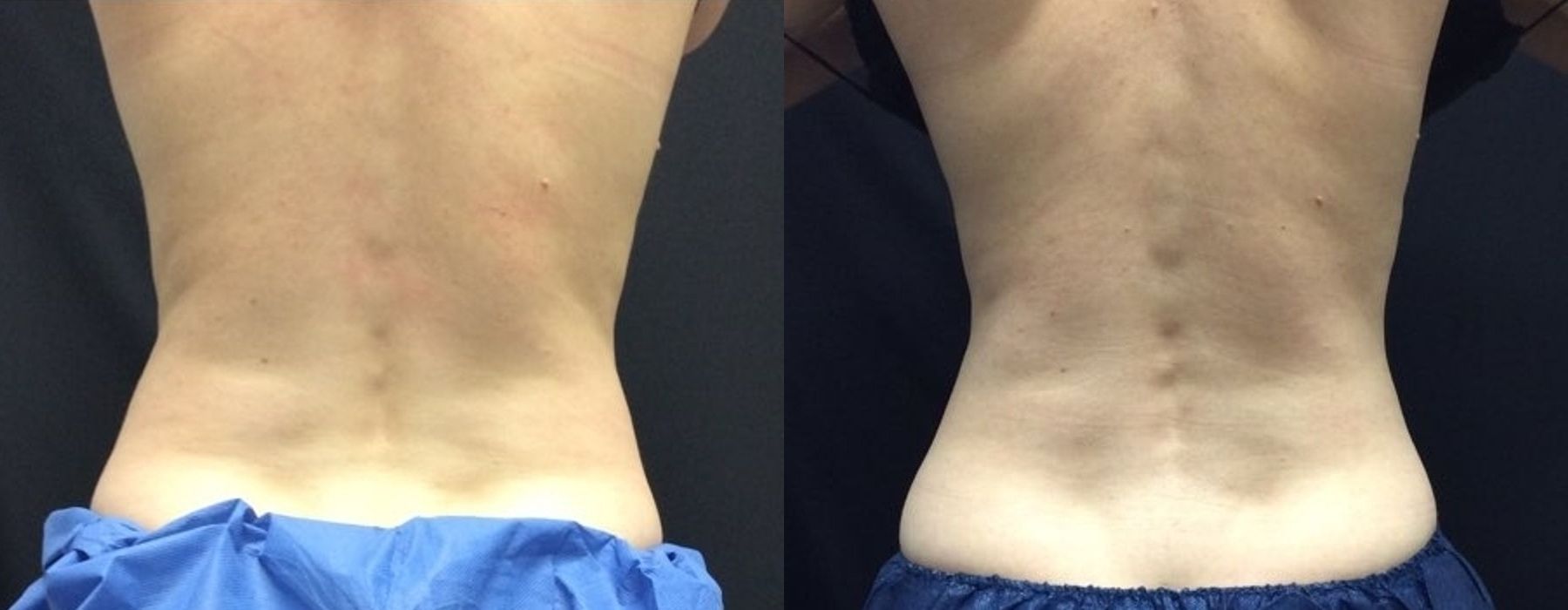 CoolSculpting Elite - Thumbnail 4