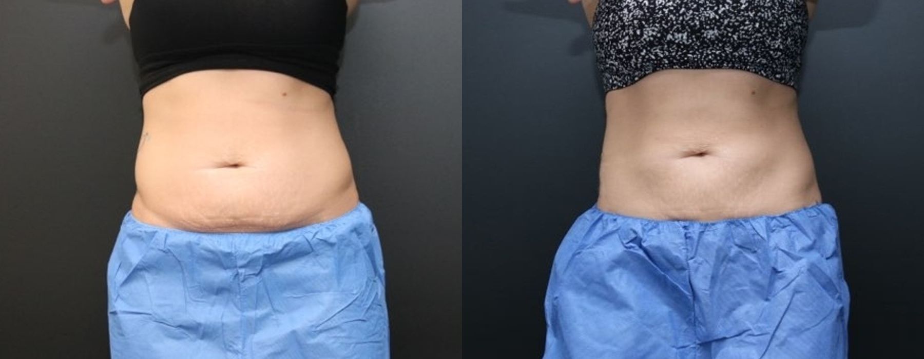 Before and after procedure result