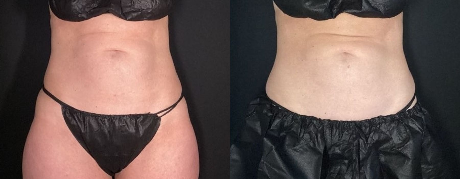 Before and after procedure result