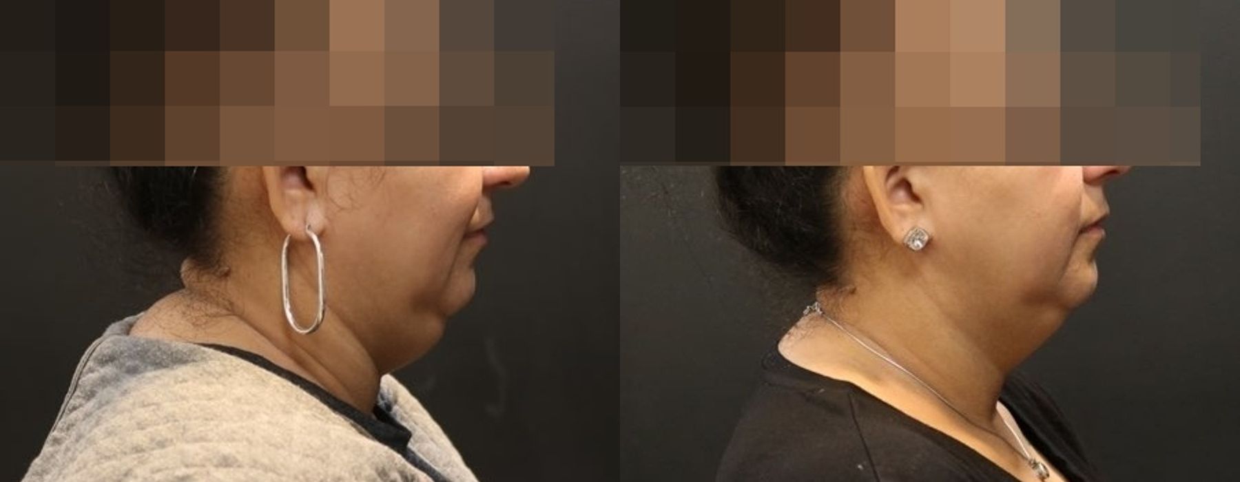 CoolSculpting Elite - Thumbnail 2