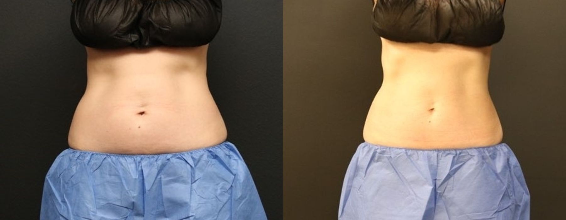 Before and after procedure result