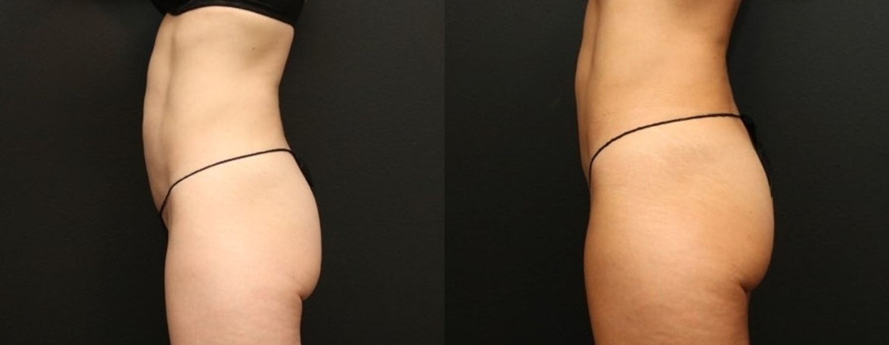 Before and after procedure result