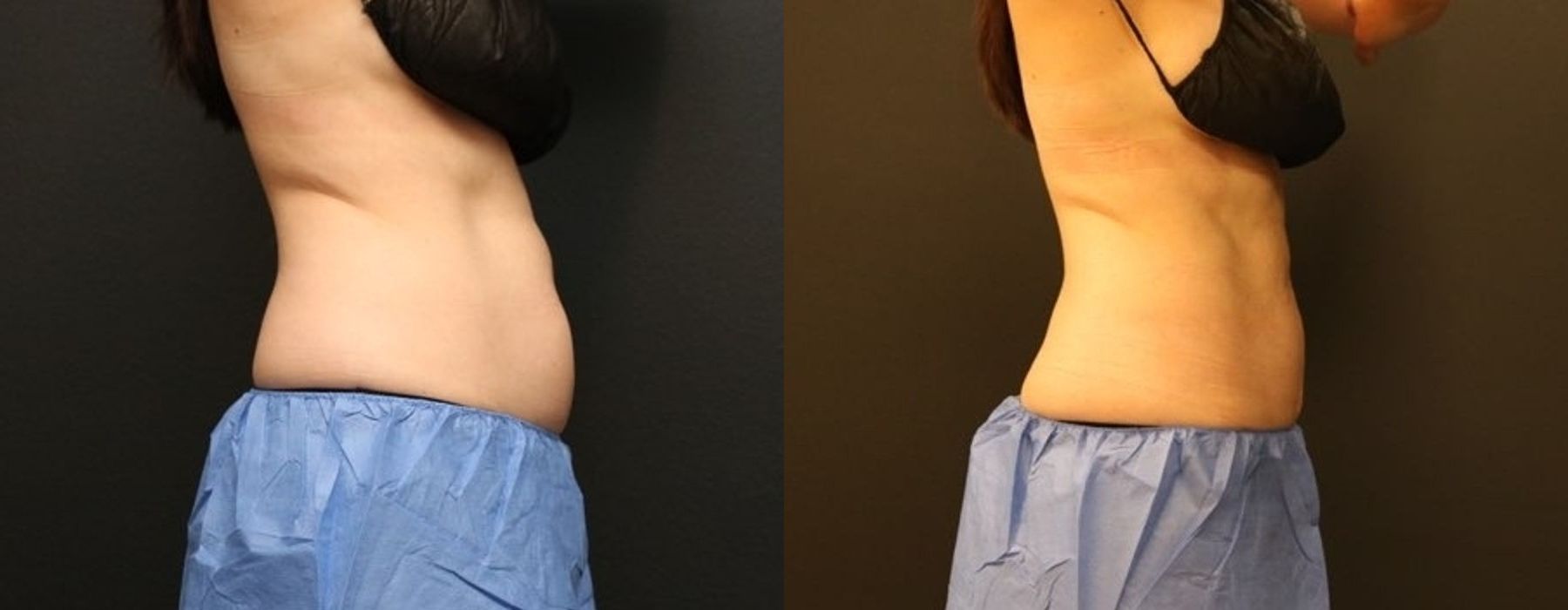 EMSCULPT - Thumbnail 4