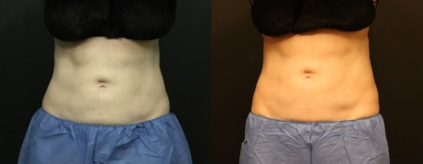 Before and after procedure result