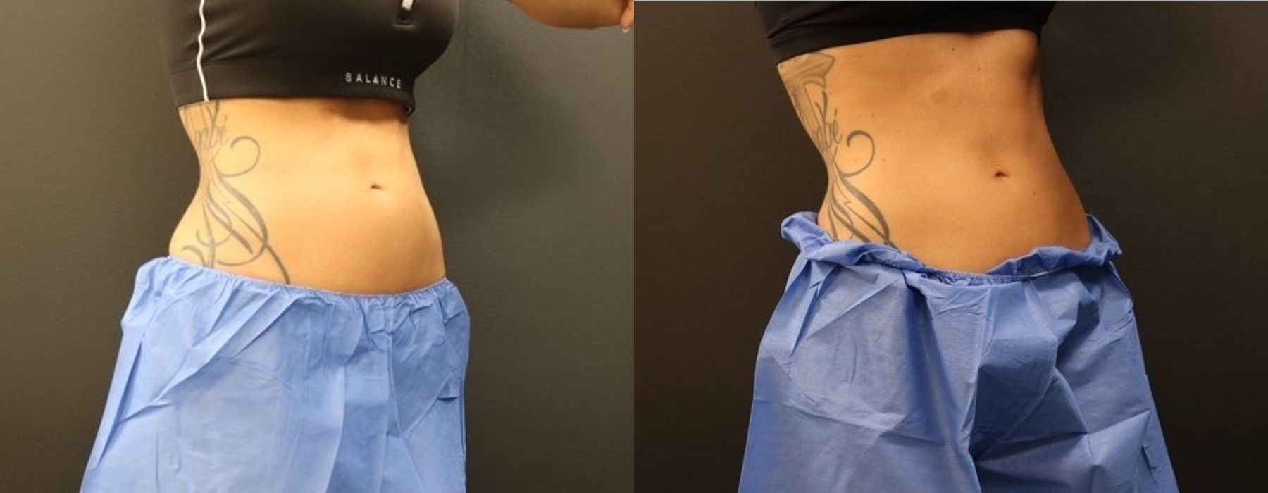 EMSCULPT - Thumbnail 2