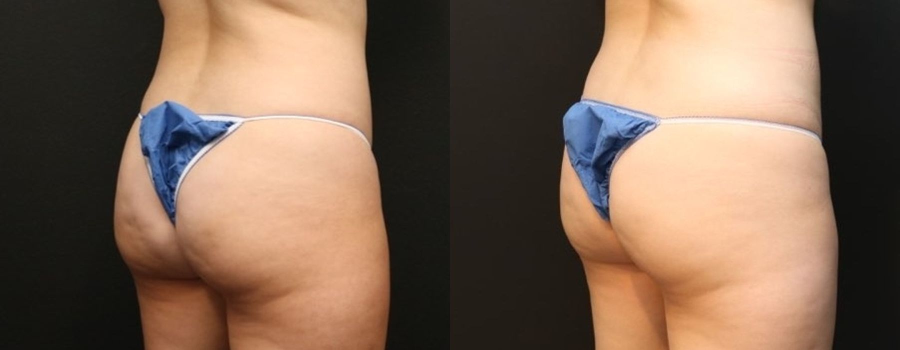 EMSCULPT - Thumbnail 4