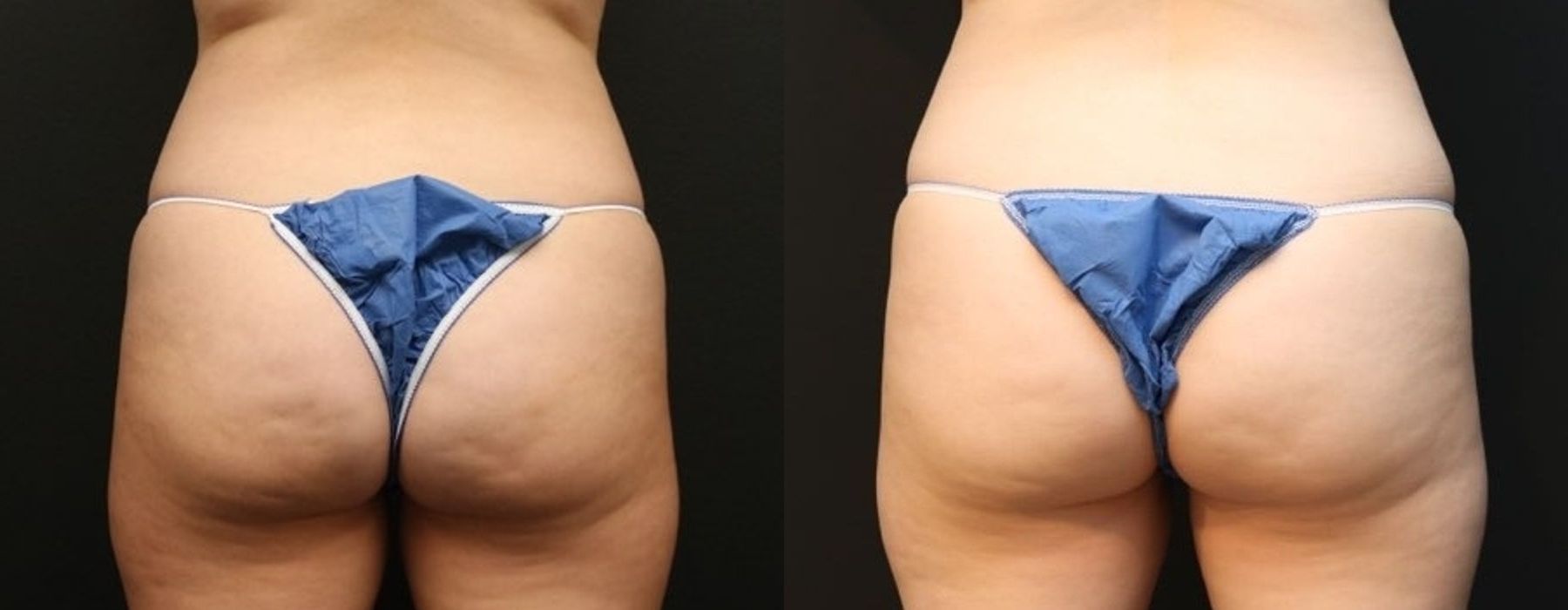 Before and after procedure result