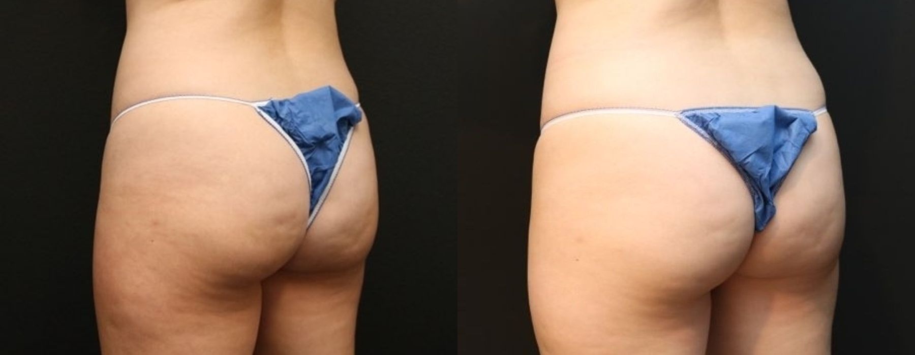 EMSCULPT - Thumbnail 2