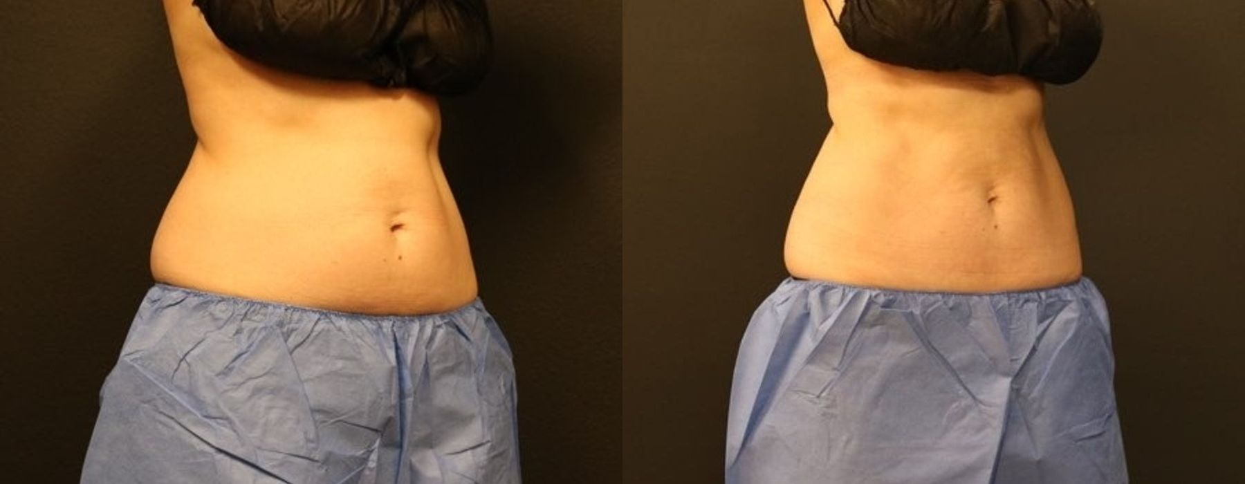 EMSCULPT - Thumbnail 3