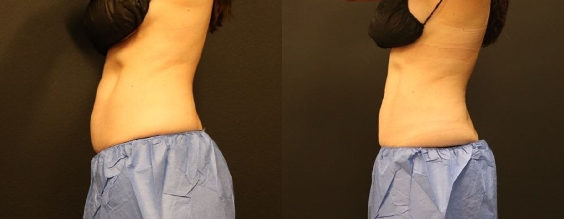 EMSCULPT - Thumbnail 2