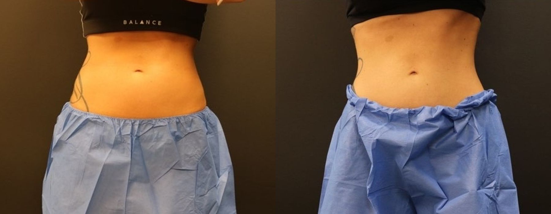 Before and after procedure result